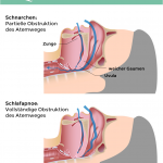 Zahnarzt Erding, Moreano, Schlafmedizin, Schnarchen, Schlafapnoe (II)